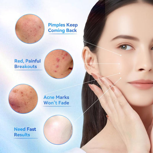 Salicylic Acid Acne Treatment