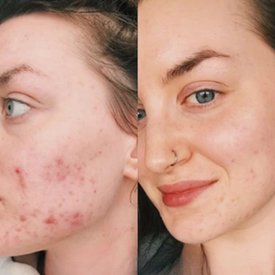 Shrink the Redness Overnight